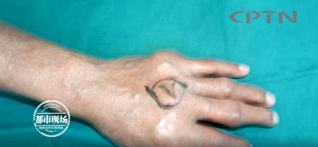 触目惊心男子手上全是囊肿已经严重畸变