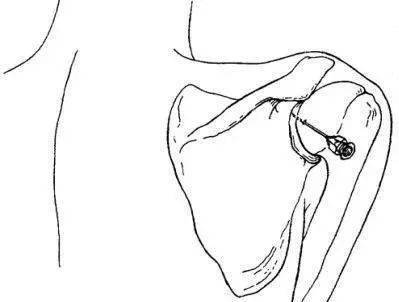 肩峰下滑囊注射定位图片