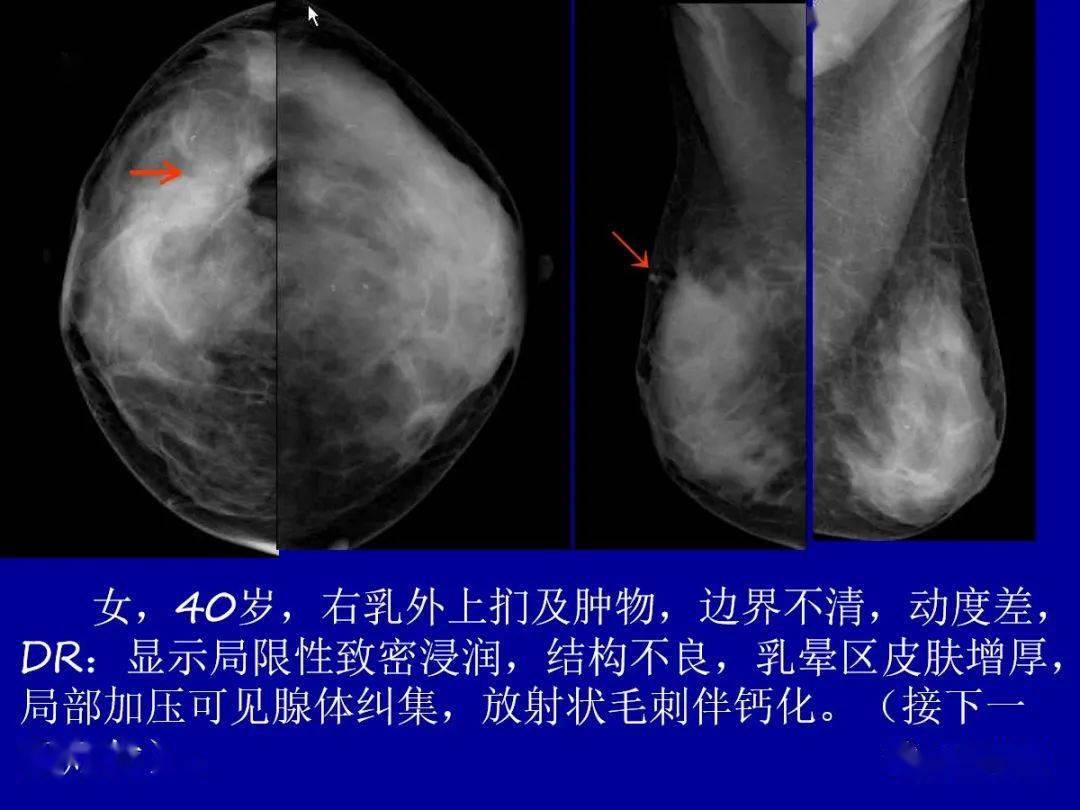 乳腺癌片子图片图片