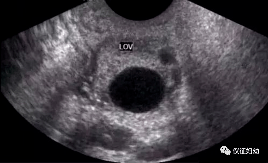 科普经阴道b超监测排卵不可不知的细节
