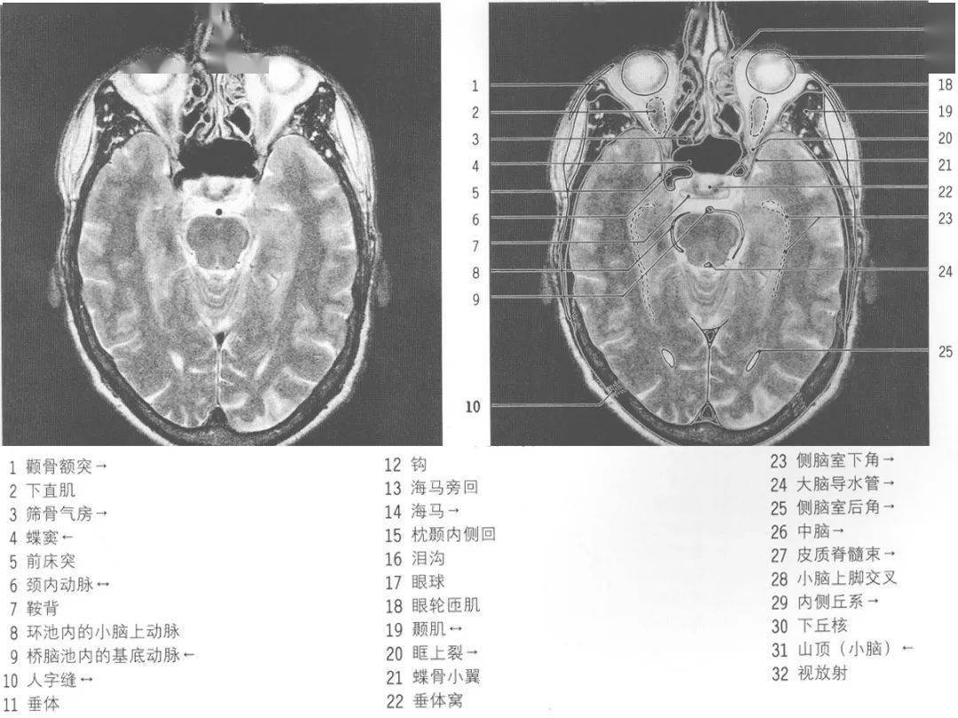 头颅磁共振定位图图片