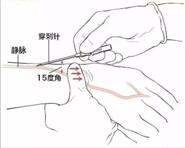 静脉穿刺的位置图解图片