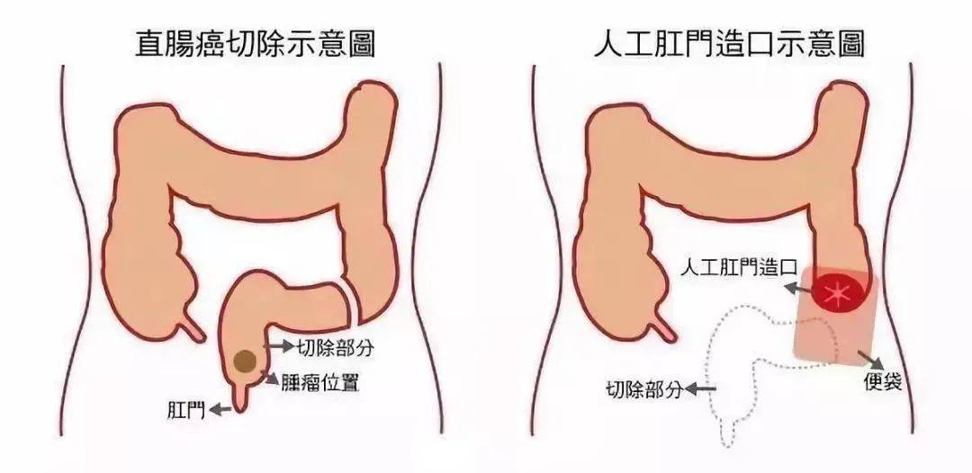 名醫科普陳福軍教授提醒您大腸癌信號來了防大於治早點和大腸癌說再見