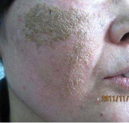 华西皮肤专家说,那是因为你的脸,洗!多!了!_污垢