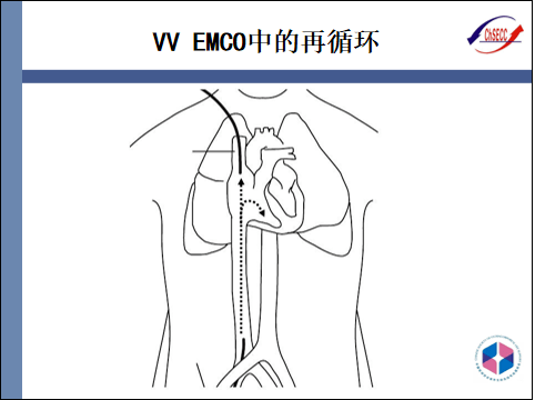 pptecmo插管技术与部位选择
