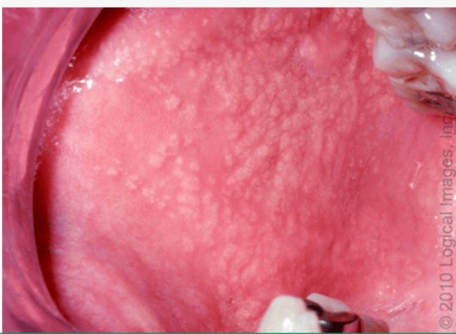 口腔黏膜皮脂腺异位图片