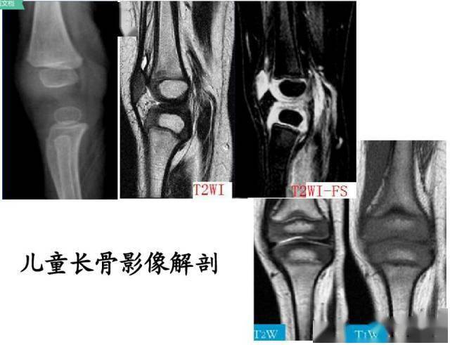 肱骨远端全骺分离1岁男孩,肘关节外伤一天(以上部分内容摘选自网络)