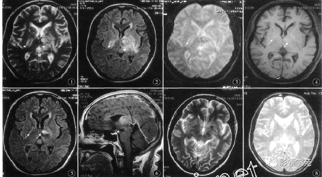 wernicke脑病mri表现