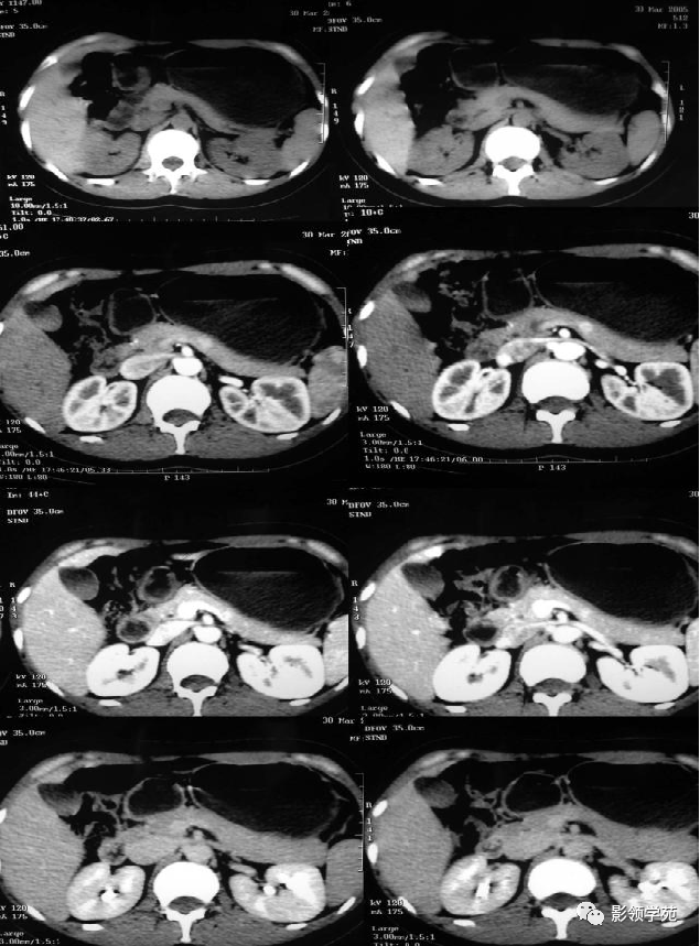 胰岛细胞瘤影像学表现