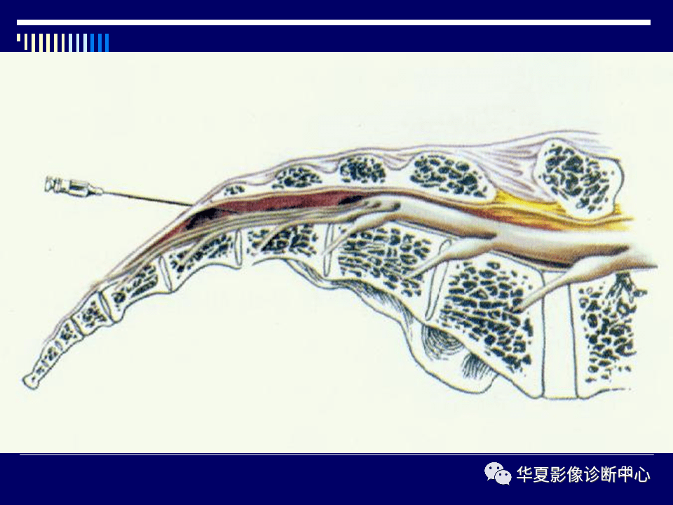 经典课件影像那些需要知道系列骶骨的解剖学变异