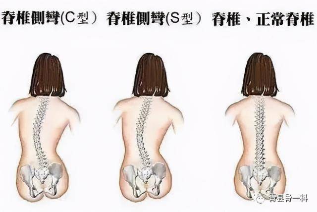 一直不采取治疗措施的话,可能会导致脊柱改变,患者在做生理弯曲,站立