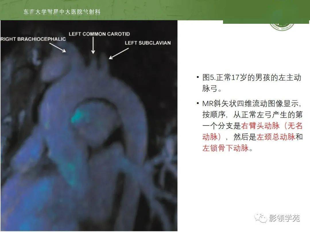 主动脉弓先天变异和异常影像表现