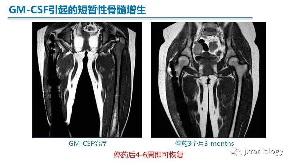 红骨髓,黄骨髓和病变 | mri表现