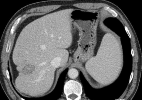 肝包膜图片图片