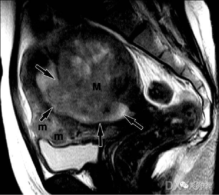 子宫MR解剖图片