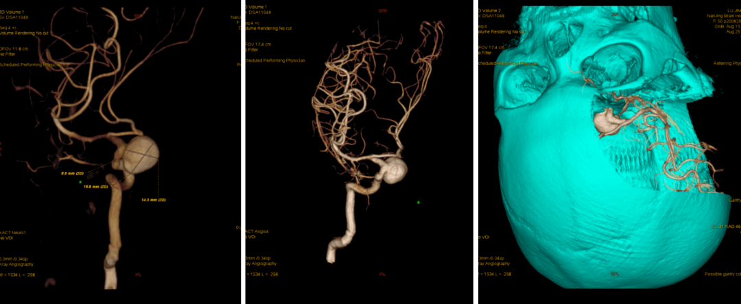 头颈部cta头颅mri头颅ct▲▲▲影像特点入院后予完善头颅dsa检查提示