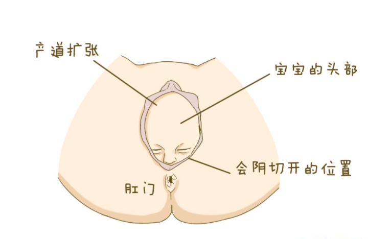 不但可以缩短产妇的疼痛时间,最大程度恢复阴道口的正常解剖结构(即