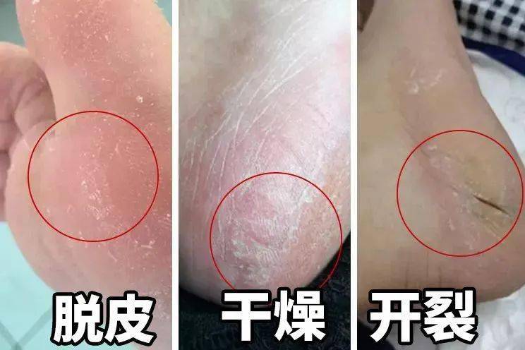 北极雪山「灵油」,3 天手脚滑又嫩,肌肤重返 16 岁!