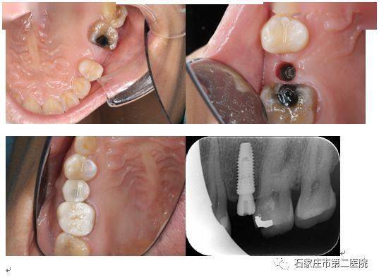 口腔种植知多少①种植牙就像挖坑种树吗