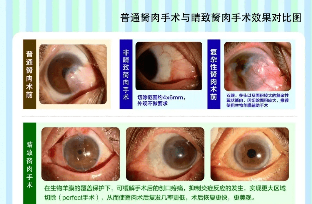 翼狀胬肉易復發,手術方式很重要.