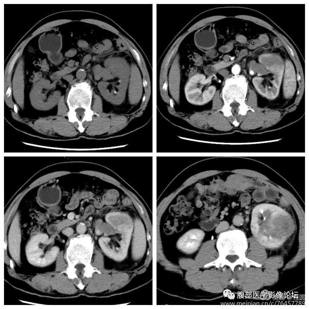 肾乳头坏死图片