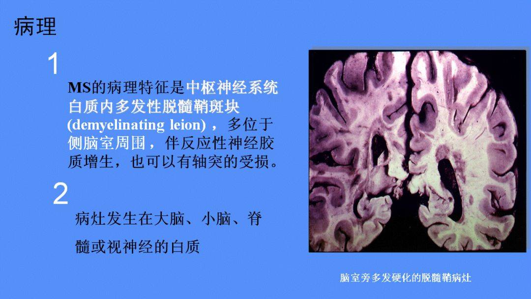 ms的病理特征是中枢神经系统白质内多发性脱髓鞘斑块.