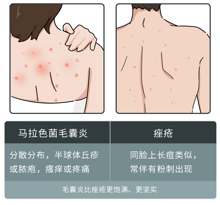 痤疮杆菌等微生物当脸上皮脂分泌