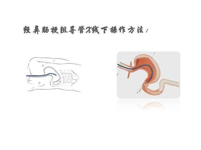 腸梗阻導管置入技術診療規範