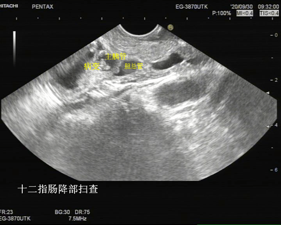 胰腺炎b超报告图图片