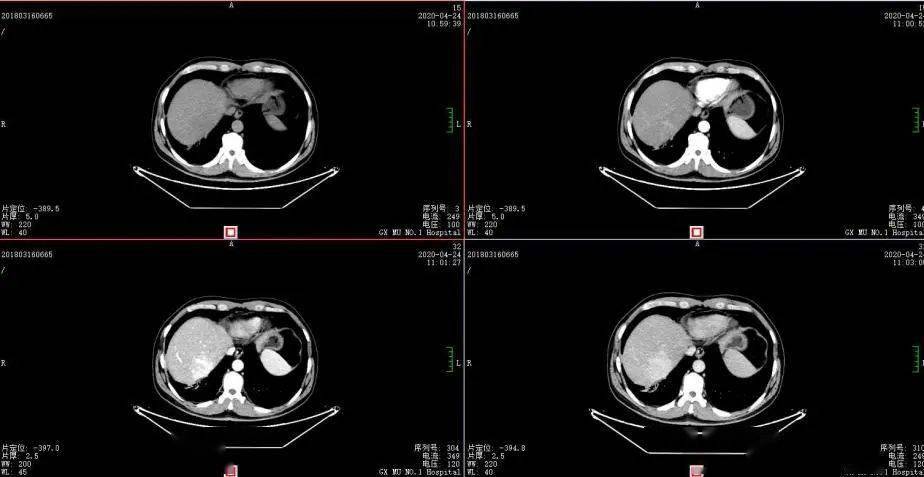 胃癌ct检查报告单图片图片