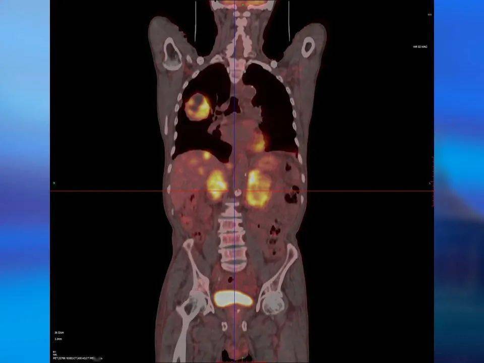 发布高建英主任petct在肿瘤远处转移中的临床应用
