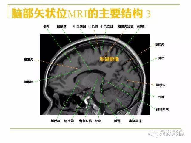 颅脑mri矢状位解剖图图片