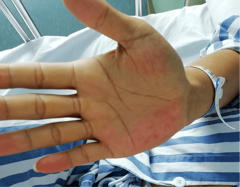 【注意】35岁男子皮肤出现"蜘蛛痣" ,发现时已肝癌晚期_传播