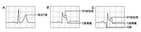 急诊宝典 5分钟快速掌握急性心梗的心电图判读