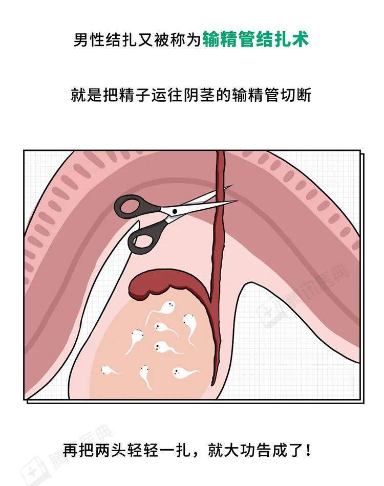 男人结扎位置图片真实图片