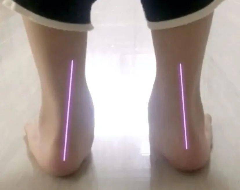 孩子走路内八or外八可能和这3个小习惯有关