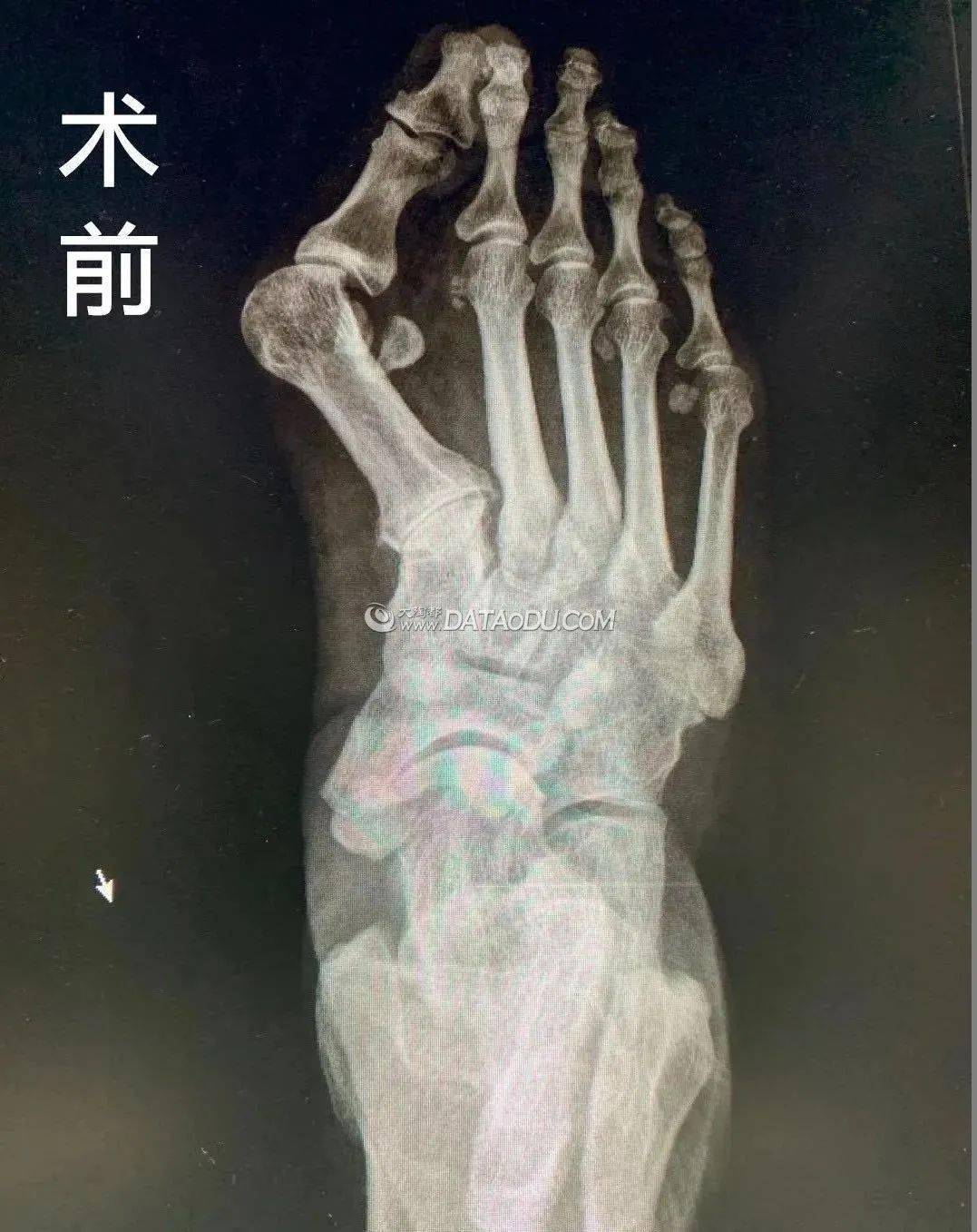 经过影像学检查,医生诊断为右足拇外翻,右扁平足,建议其住院手术治疗