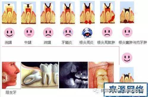 齲齒(蟲牙)的前生今世