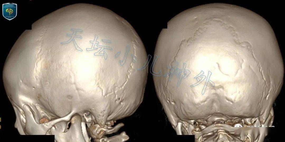 颅面骨畸形图片