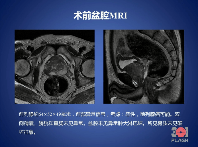 特殊类型前列腺癌患者的手术策略