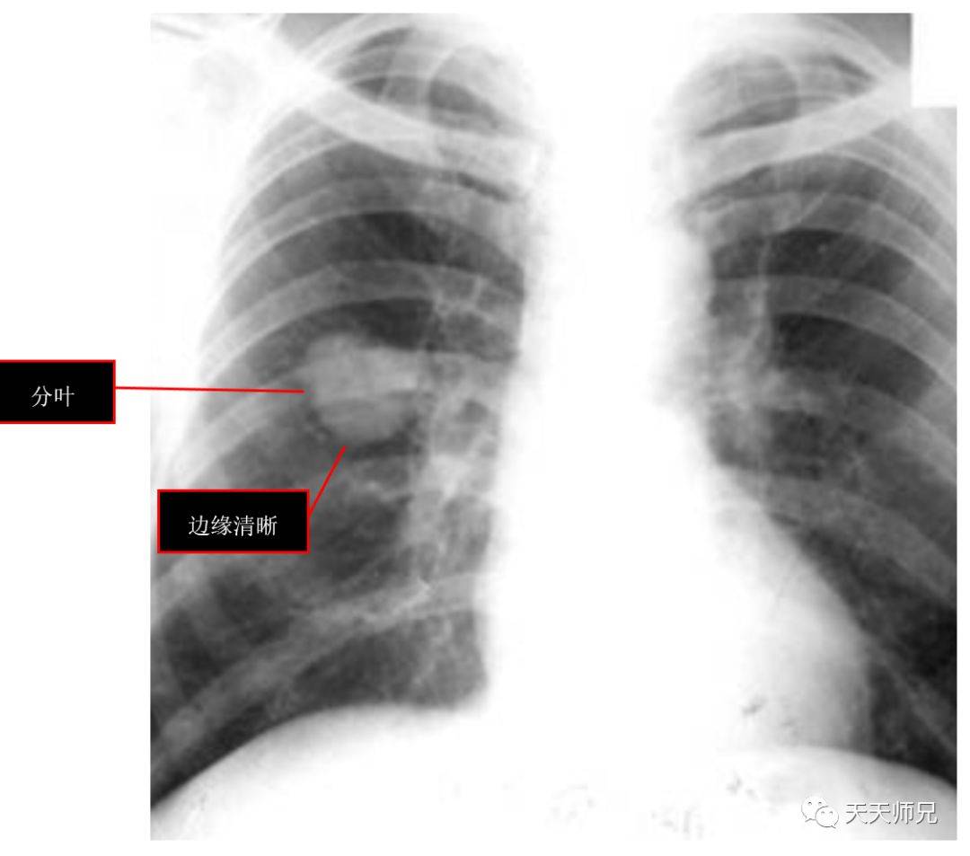 周围型肺癌x线图片图片