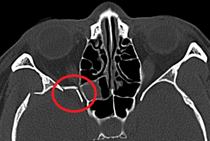 术前ct见右眼眶外侧壁骨折,视神经管受压