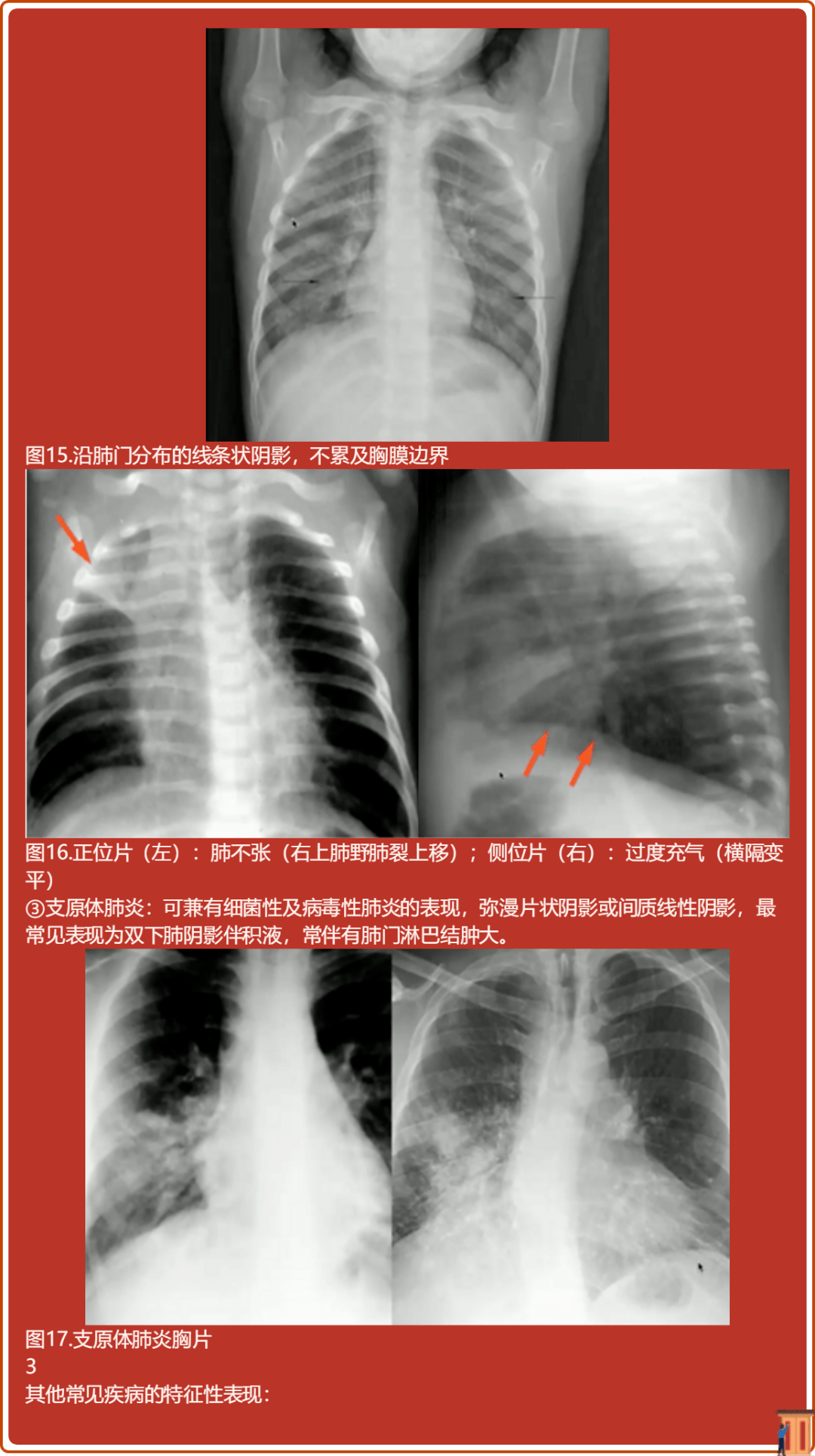 肺门蝴蝶状阴影图片
