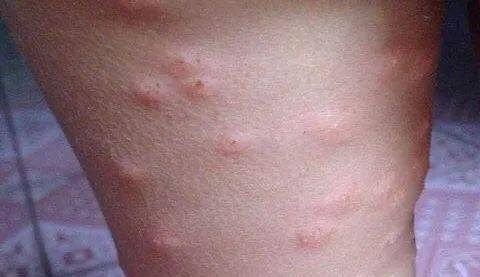 湿疹腿部的红疙瘩发痒,也可能是湿疹造成的,这种疾病的特点是容易复发