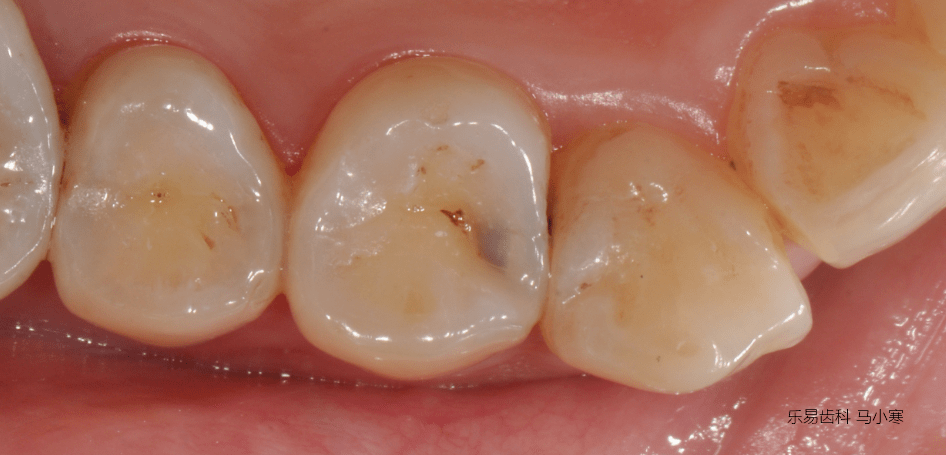 右上尖牙远中邻面浅度龋齿诊断否认遗传类疾病,否认过敏性药物史家族
