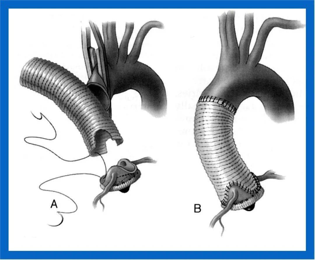 获"心"生——天津医大二院心血管外科成功完成重症wheat 半弓置换手术