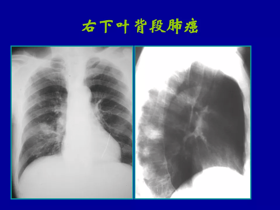 胸部X线检查结果肺部有阴影是肺癌吗？