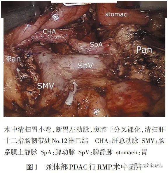 術式討論|胰腺中段切除術:從開放到微創(本文配發視頻)_腫瘤