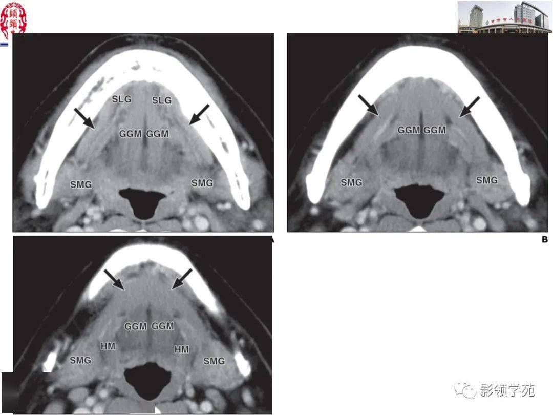 舌下腺ct断层解剖图图片