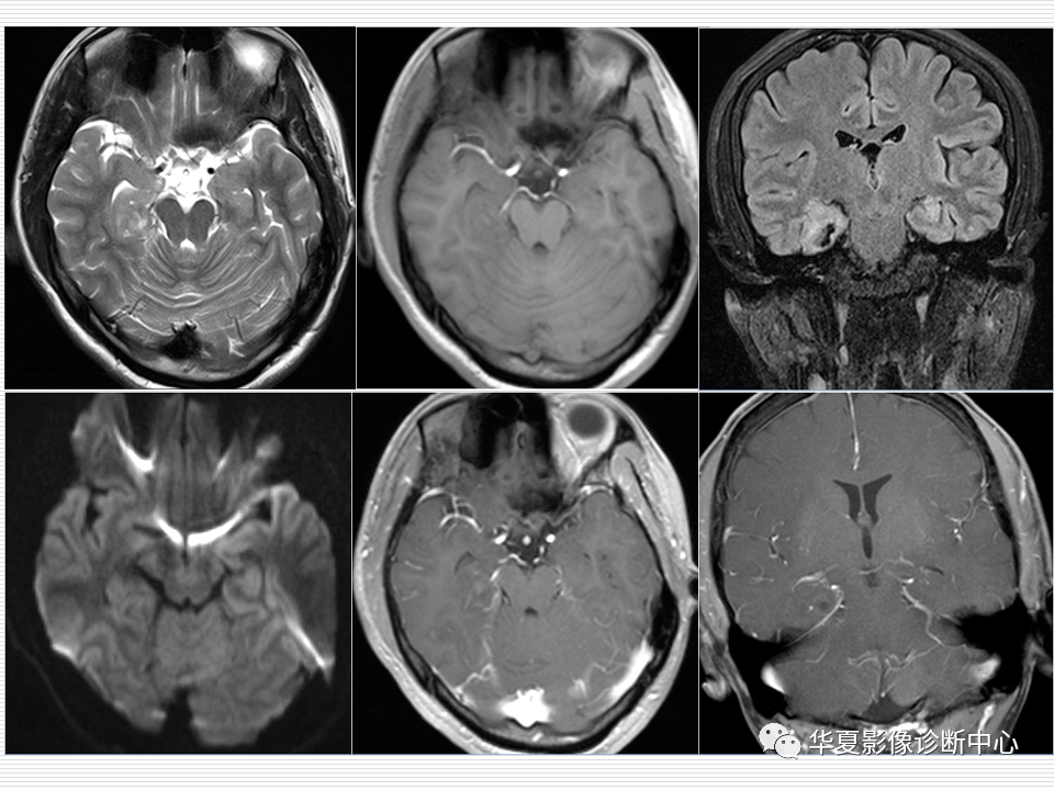 关于海马硬化的影像诊断